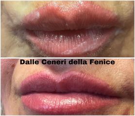 Filler labbra - Centro medico estetico dalle ceneri della fenice di Dott.ssa Marceddu