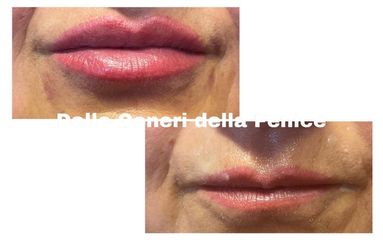 Filler labbra - Centro medico estetico dalle ceneri della fenice di Dott.ssa Marceddu