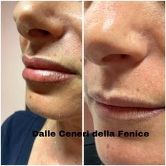 Laser CO2 e filler labbra - Centro medico estetico dalle ceneri della fenice di Dott.ssa Marceddu