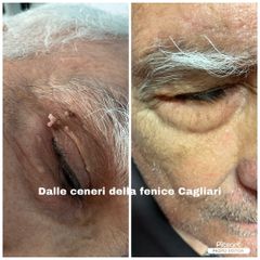 Laser CO2 - Centro medico estetico dalle ceneri della fenice di Dott.ssa Marceddu