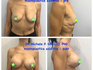 Mastoplastica additiva prima e dopo