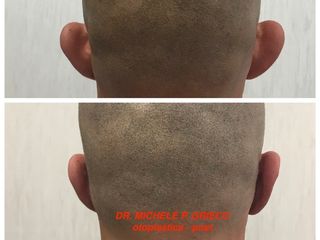 Otoplastica prima e dopo