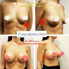 Mastoplastica additiva - Dr. Michele P. Grieco, PhD