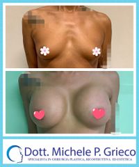 Mastoplastica additiva - Dr. Michele P. Grieco, PhD