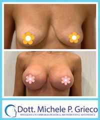 Mastoplastica additiva - Dr. Michele P. Grieco, PhD