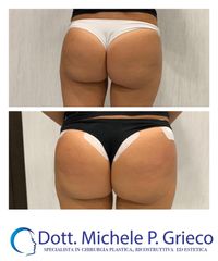 Filler glutei - Dr. Michele P. Grieco, PhD