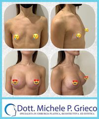 Mastoplastica additiva - Dr. Michele P. Grieco, PhD