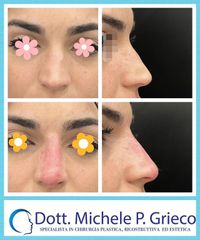 Rinofiller - Dr. Michele P. Grieco, PhD