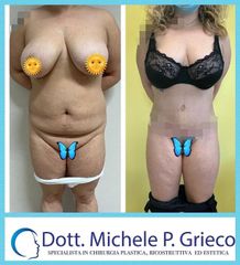 Addominoplastica - Dr. Michele P. Grieco, PhD