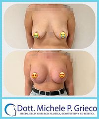 Mastopessi - Dr. Michele P. Grieco, PhD