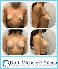 Mastoplastica additiva - Dr. Michele P. Grieco, PhD