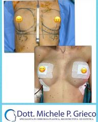 Mastoplastica additiva - Dr. Michele P. Grieco, PhD