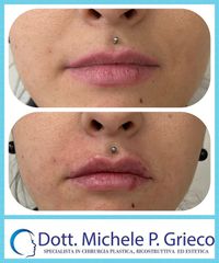 Filler labbra - Dr. Michele P. Grieco, PhD