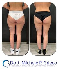 Liposuzione - Dr. Michele P. Grieco, PhD