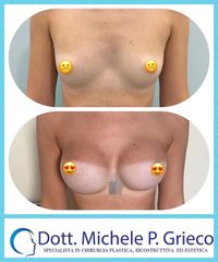 Mastoplastica additiva - Dr. Michele P. Grieco, PhD