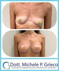 Mastoplastica additiva - Dr. Michele P. Grieco, PhD