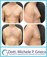 Ginecomastia - Dr. Michele P. Grieco, PhD