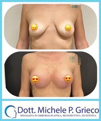 Mastoplastica additiva - Dr. Michele P. Grieco, PhD