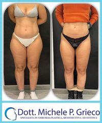 Liposuzione - Dr. Michele P. Grieco, PhD