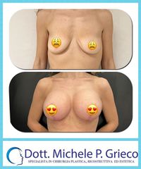 Mastoplastica additiva - Dr. Michele P. Grieco, PhD