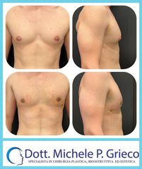 Ginecomastia - Dr. Michele P. Grieco, PhD
