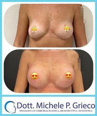 Mastoplastica additiva - Dr. Michele P. Grieco, PhD