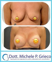 Mastoplastica additiva - Dr. Michele P. Grieco, PhD