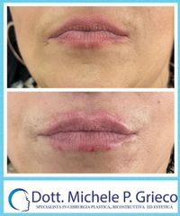 Filler labbra  - Dr. Michele P. Grieco, PhD
