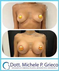 Mastoplastica additiva - Dr. Michele P. Grieco, PhD