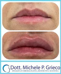 Filler labbra  - Dr. Michele P. Grieco, PhD