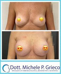 Mastoplastica additiva - Dr. Michele P. Grieco, PhD