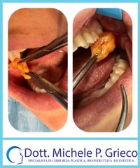 Rimozione bolle di bichat, Dr. Michele P. Grieco, PhD