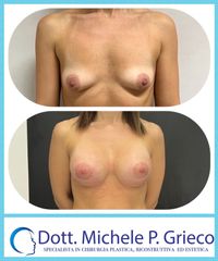 Mastoplastica Additiva - Dr. Michele P. Grieco, PhD