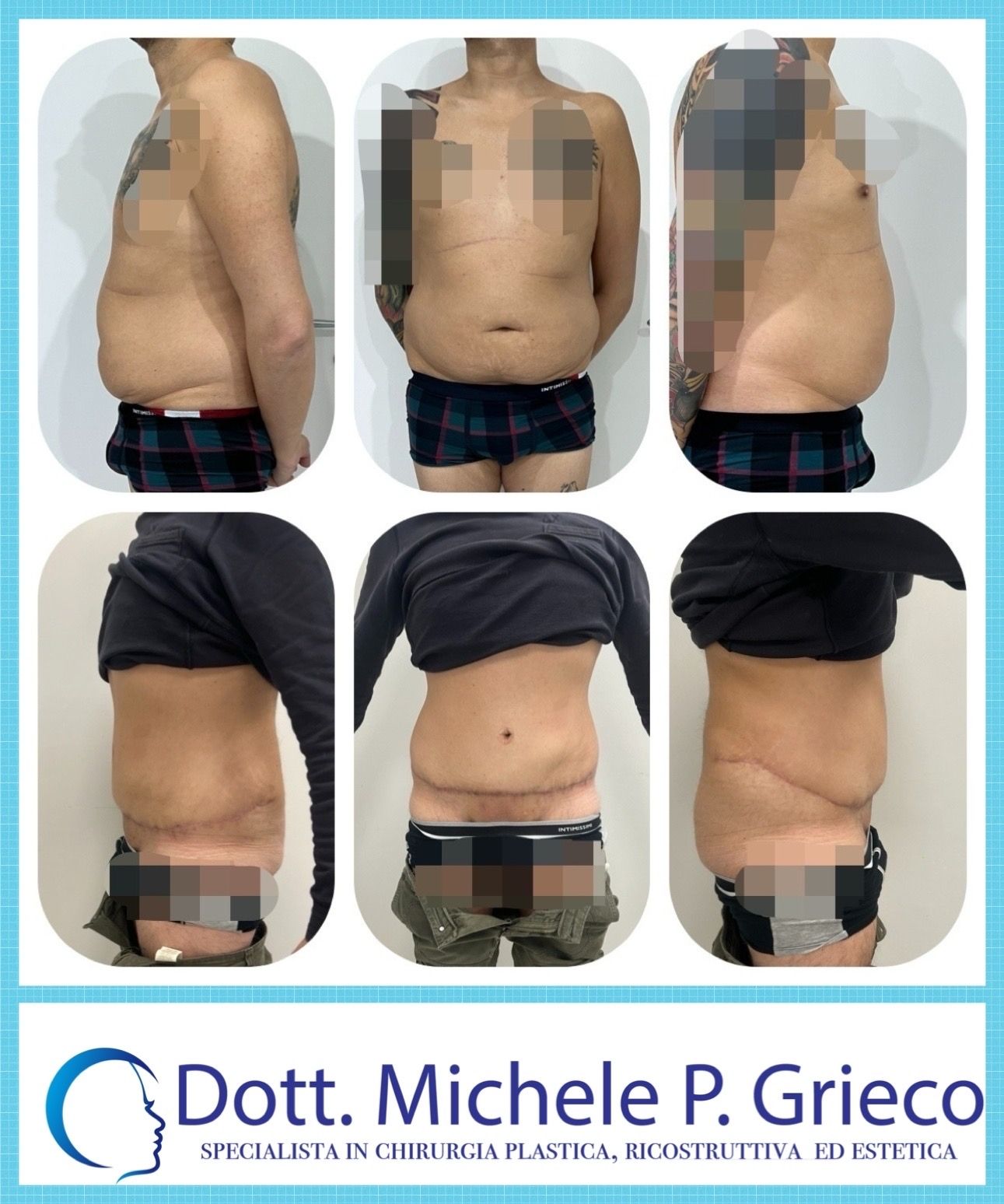 Addominoplastica Prima e dopo Guidaestetica.it Guidaestetica.it