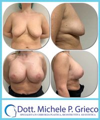 Mastopessi con protesi - Dr. Michele P. Grieco, PhD