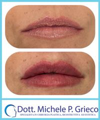 Filler labbra - Dr. Michele P. Grieco, PhD