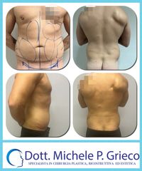 Liposuzione - Dr. Michele P. Grieco, PhD