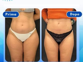 Liposuzione prima e dopo - 878972