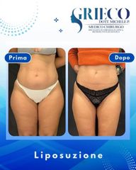 Dr. Michele P. Grieco, PhD Liposuzione