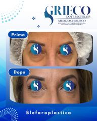 Dr. Michele P. Grieco, PhD Blefaroplastica