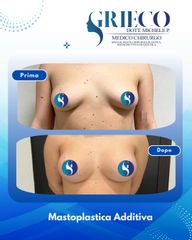 Dr. Michele P. Grieco, PhD Mastoplastica Additiva