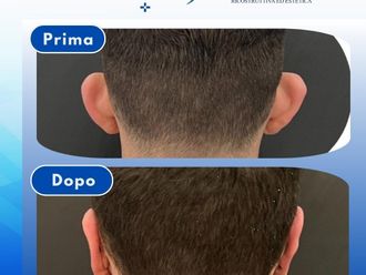 Otoplastica prima e dopo - 878977