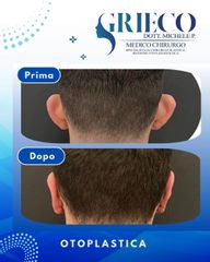 Dr. Michele P. Grieco, PhD Otoplastica
