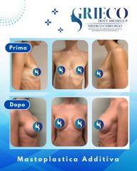 Dr. Michele P. Grieco, PhD Mastoplastica Additiva