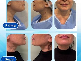 Liposuzione prima e dopo - 878981