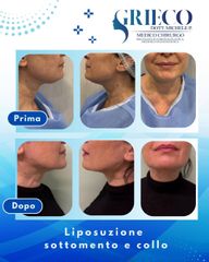 Dr. Michele P. Grieco, PhD Liposuzione sottomento e collo
