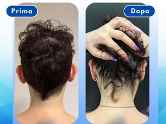 Otoplastica prima e dopo - 878982
