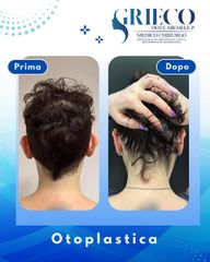 Dr. Michele P. Grieco, PhD Otoplastica