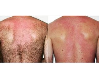 epilazione laser luce pulsata prima dopo
