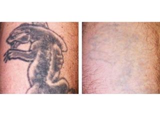 RImozione tatuaggi prima dopo